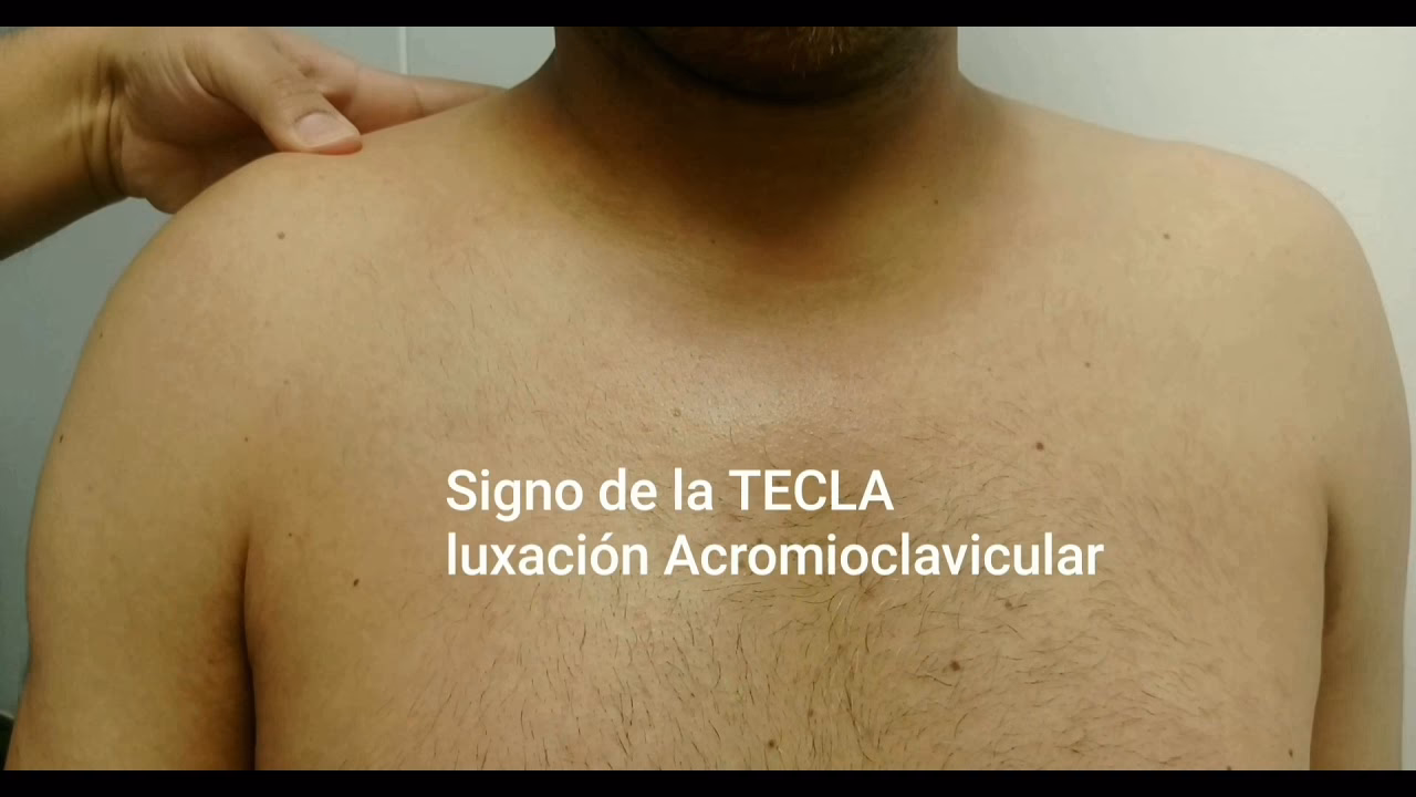 ¿Qué es el fenómeno de la tecla de piano de la clavícula?